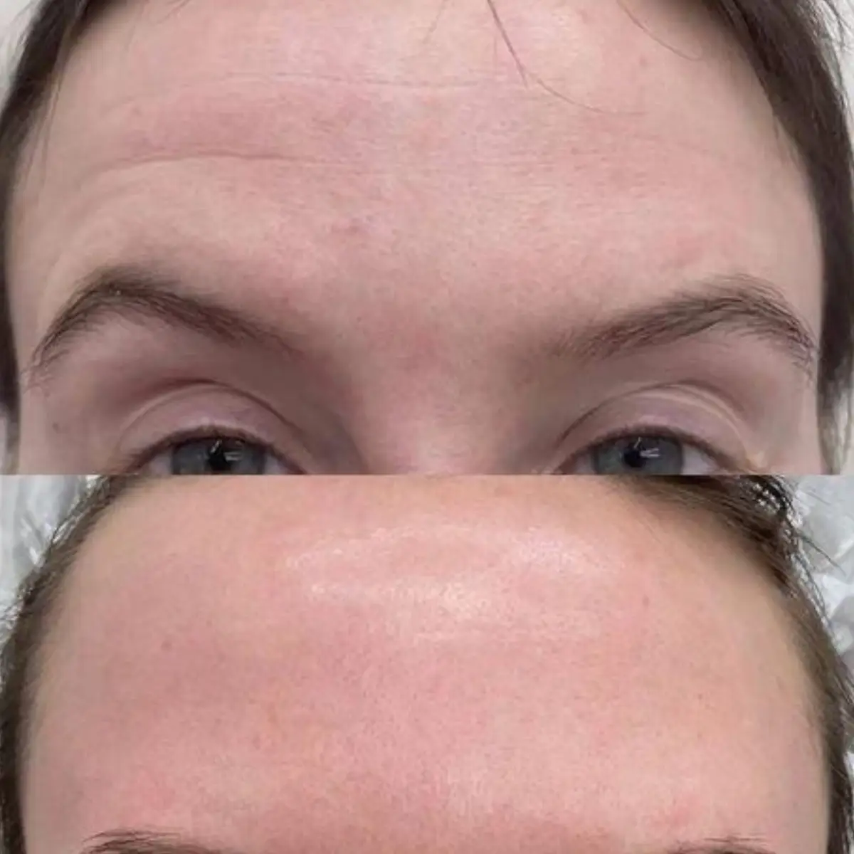 Botox forehead before and after Grapevine TX
