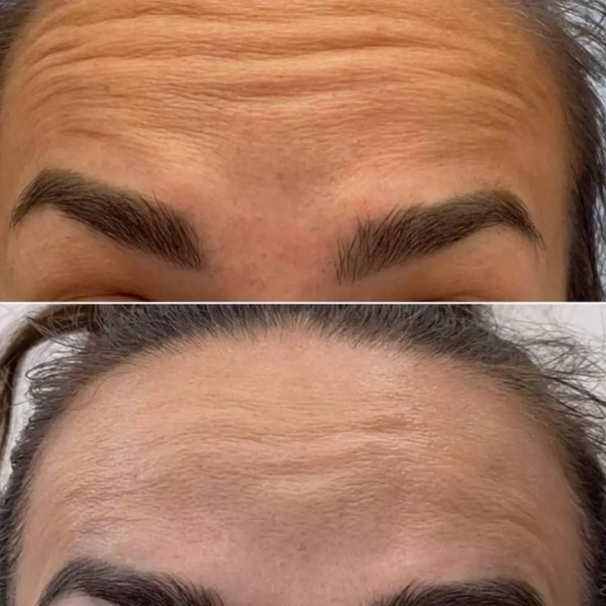 Forehead wrinkle Botox results before and after Grapevine TX