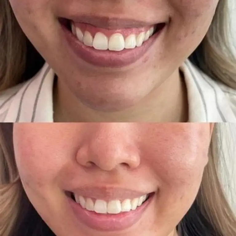 Botox gummy smile correction before and after Grapevine TX
