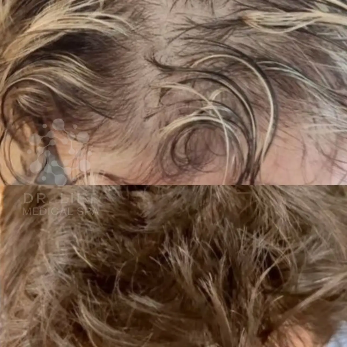 PRP PRF Grapevine TX before and after hair restoration results