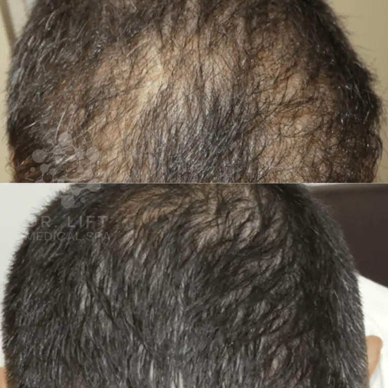 PRP hair restoration before and after in Grapevine TX showing improved hair density and reduced crown thinning