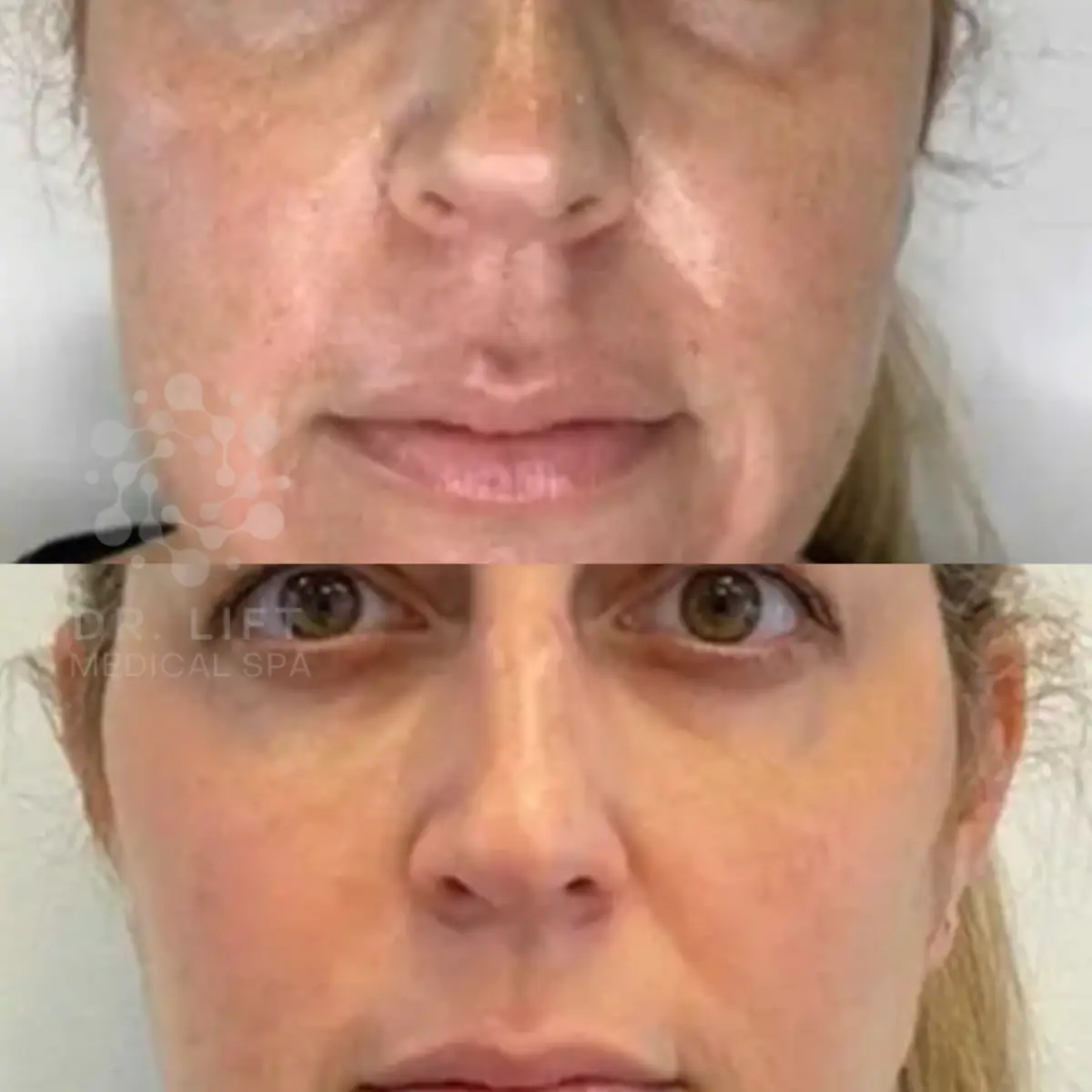 PRP facial before and after in Grapevine TX improving skin tone texture and natural glow