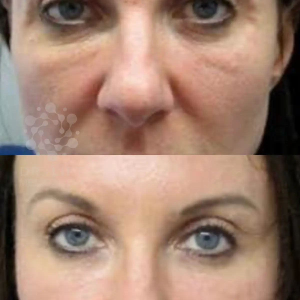 PRF under eye treatment before and after in Grapevine TX reducing dark circles and improving brightness