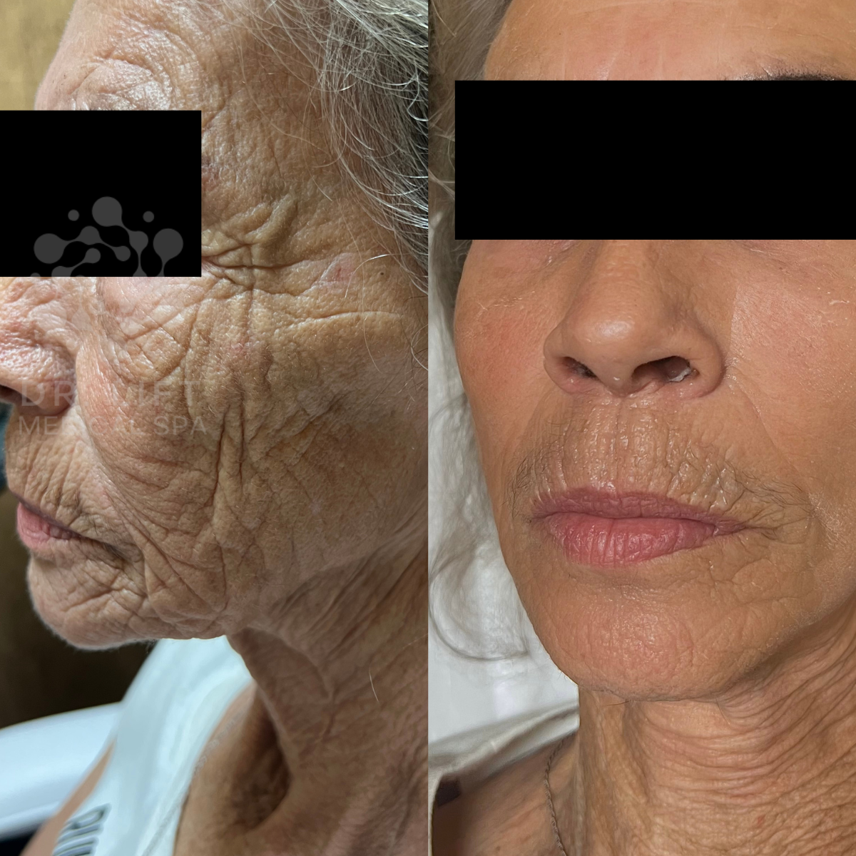 Facial skin tightening before and after in Grapevine TX showing improved firmness and reduced fine lines