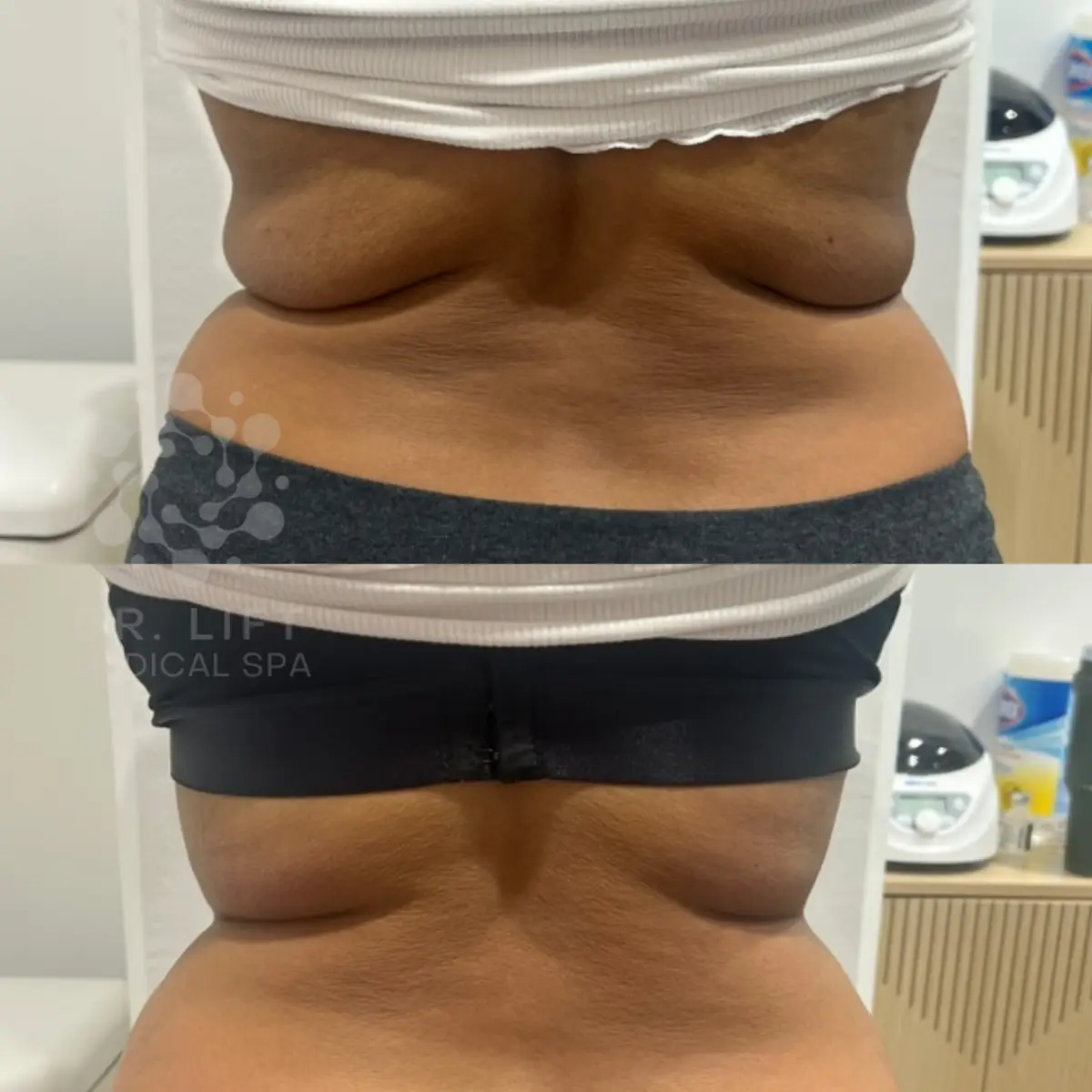 Upper back and bra bulge fat reduction results in Grapevine TX after body contouring treatment
