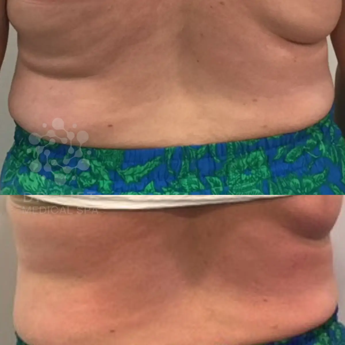 Back fat reduction and bra line contouring before and after in Grapevine TX after one session