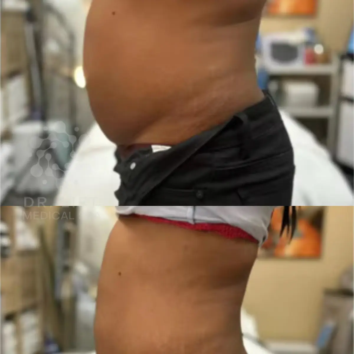 Stomach fat reduction and skin tightening results in Grapevine TX after multiple body contouring sessions