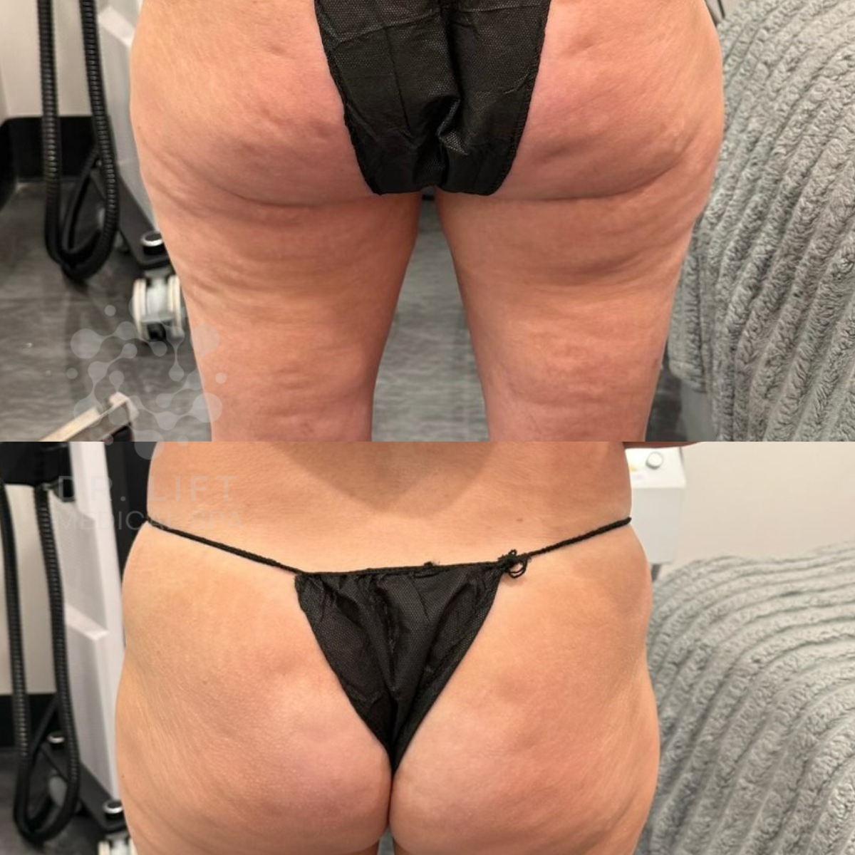 Buttocks contouring and cellulite reduction results in Grapevine TX after one body contouring session
