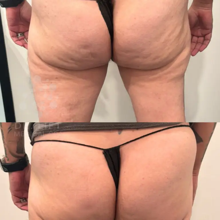 Body contouring buttocks cellulite reduction before and after Grapevine TX showing smoother skin after one session