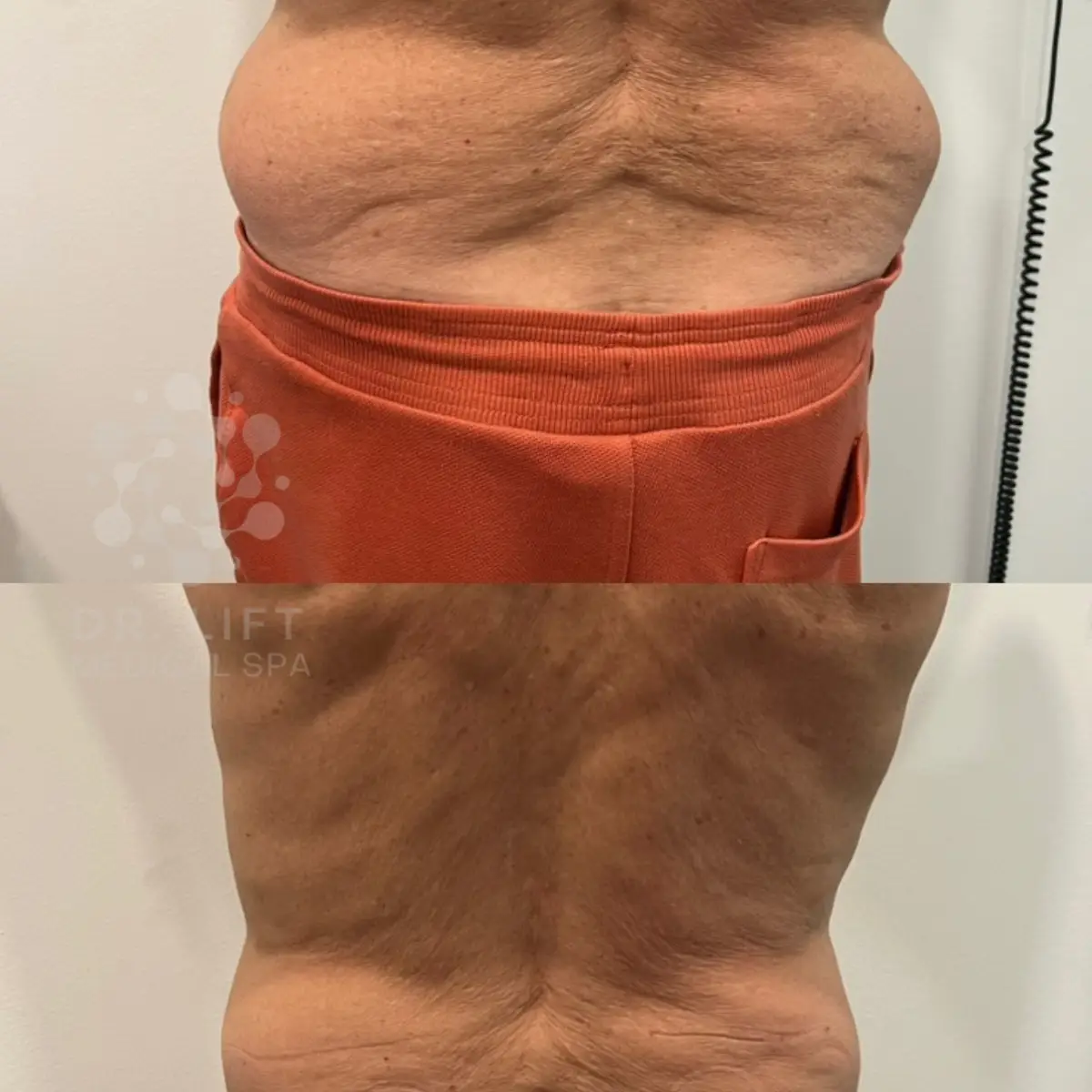 Flank slimming and waist contouring results in Grapevine TX after one body contouring treatment
