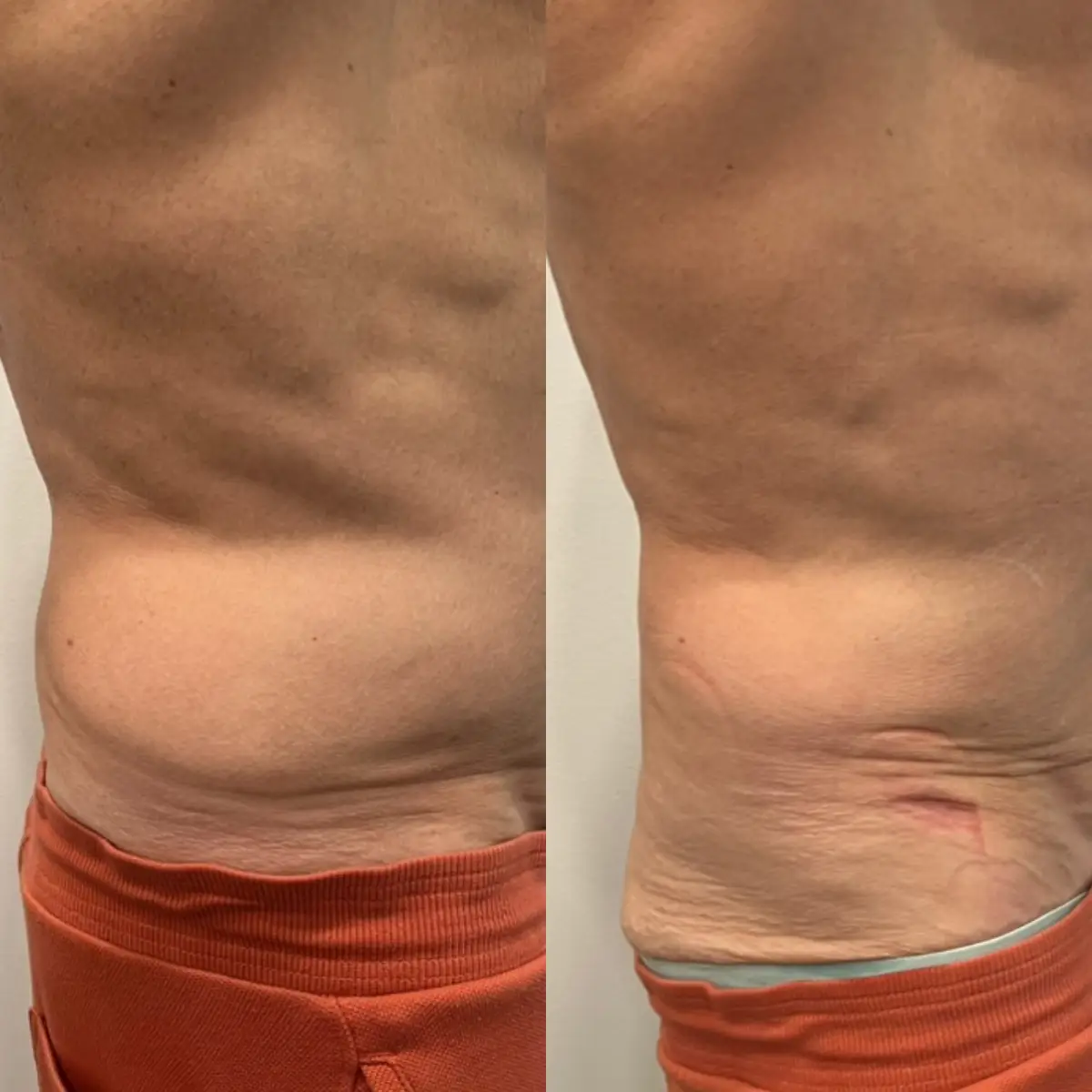 Love handles fat reduction before and after body contouring in Grapevine TX after one session