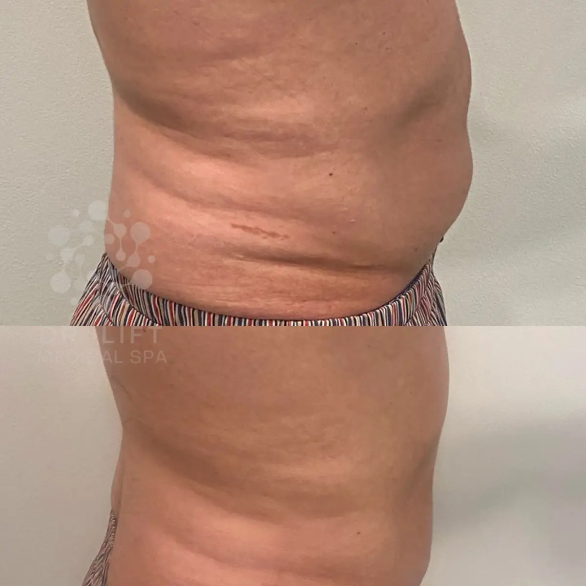 Stomach and side fat reduction before and after body contouring in Grapevine TX after one session