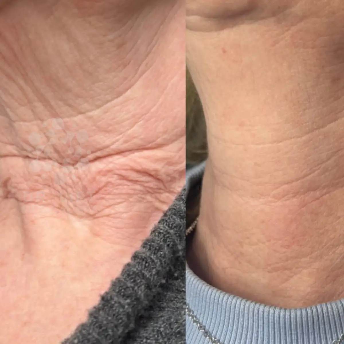 Neck skin tightening before and after in Grapevine TX showing reduced sagging and improved firmness