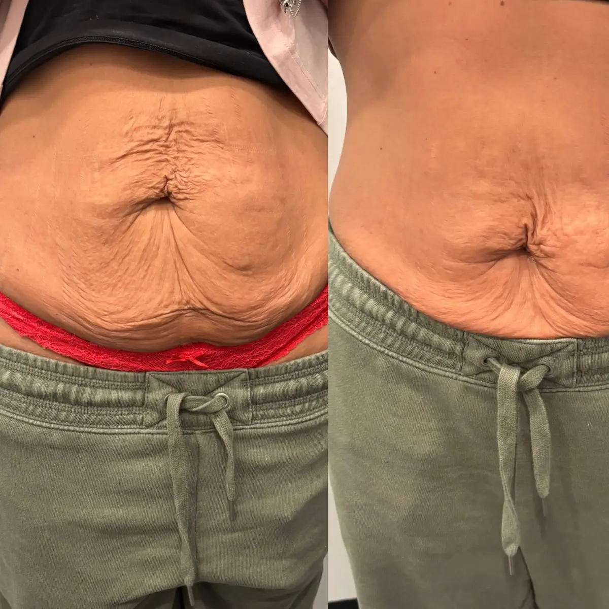 Stomach skin tightening after weight loss in Grapevine TX showing reduced loose skin and improved elasticity