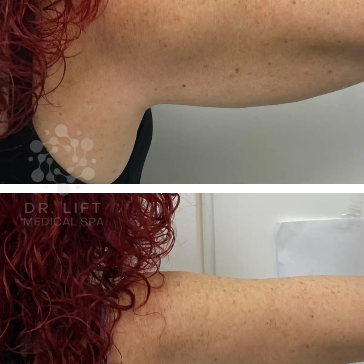 Underarm skin tightening before and after in Grapevine TX showing reduced loose skin and improved tone