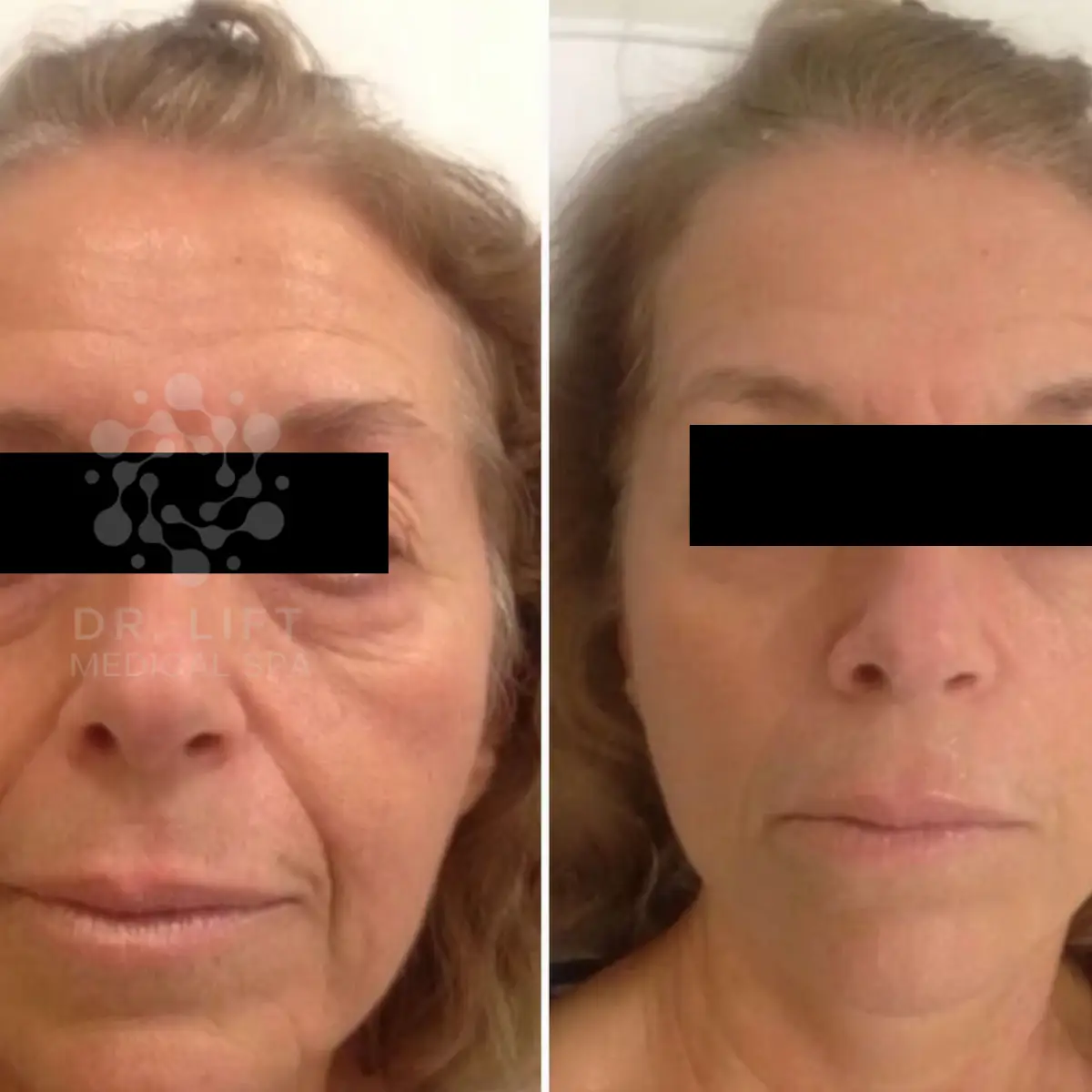 RF facial skin tightening results in Grapevine TX showing lifted appearance and improved skin texture