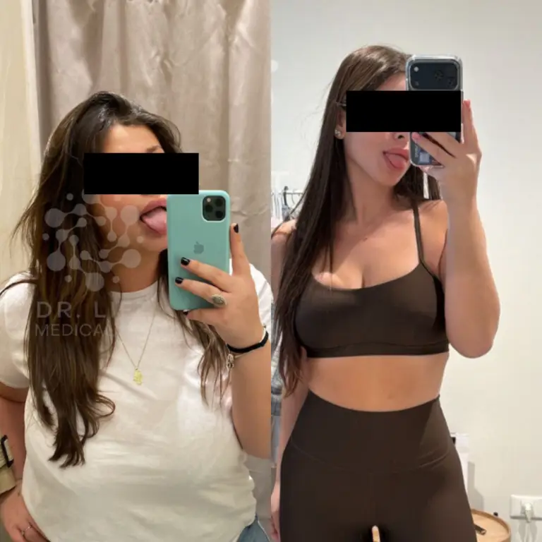 Abdomen skin tightening results in Grapevine TX after body contouring sessions showing firmer and smoother skin