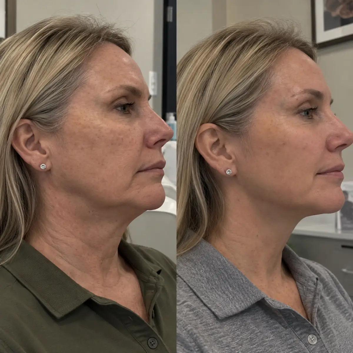 Nefertiti neck lift before and after in Grapevine TX showing natural-looking jawline contouring