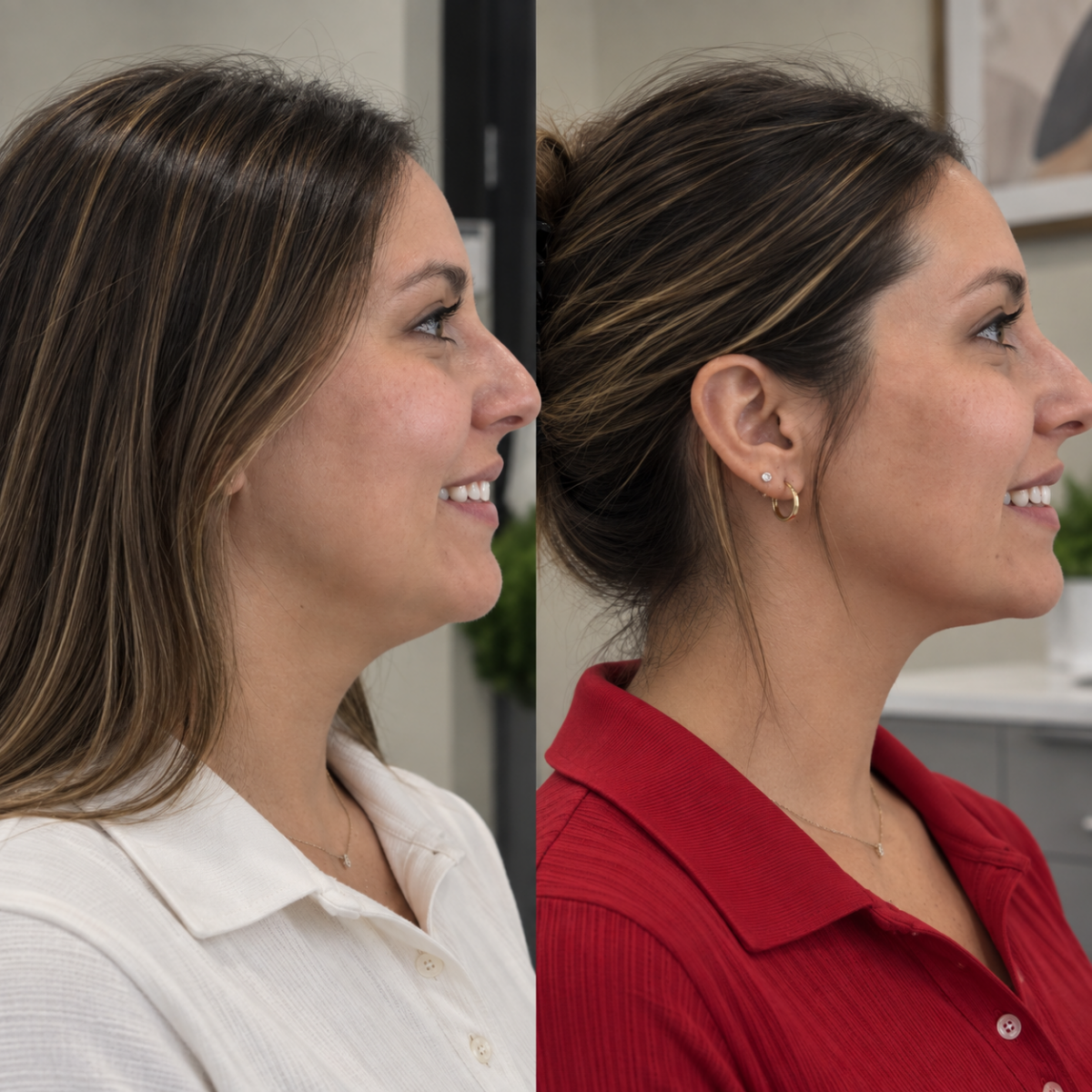 Nefertiti Lift Grapevine TX before and after showing improved jawline and neck definition