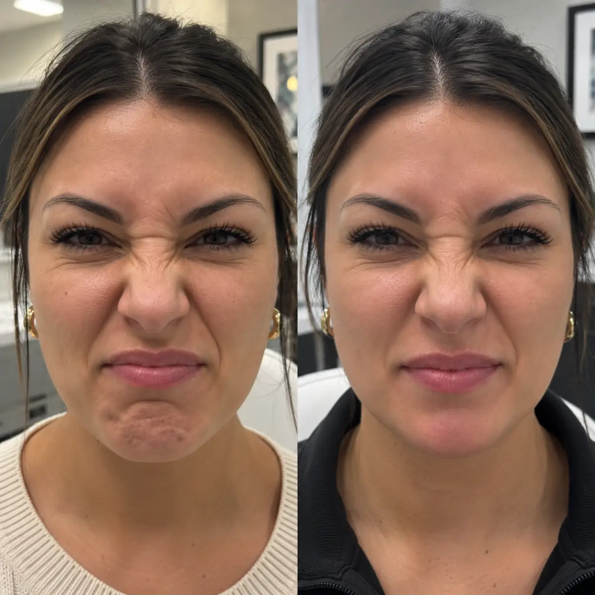 Female patient before and after Chin Letybo Grapevine TX showing smoother chin texture during facial expression