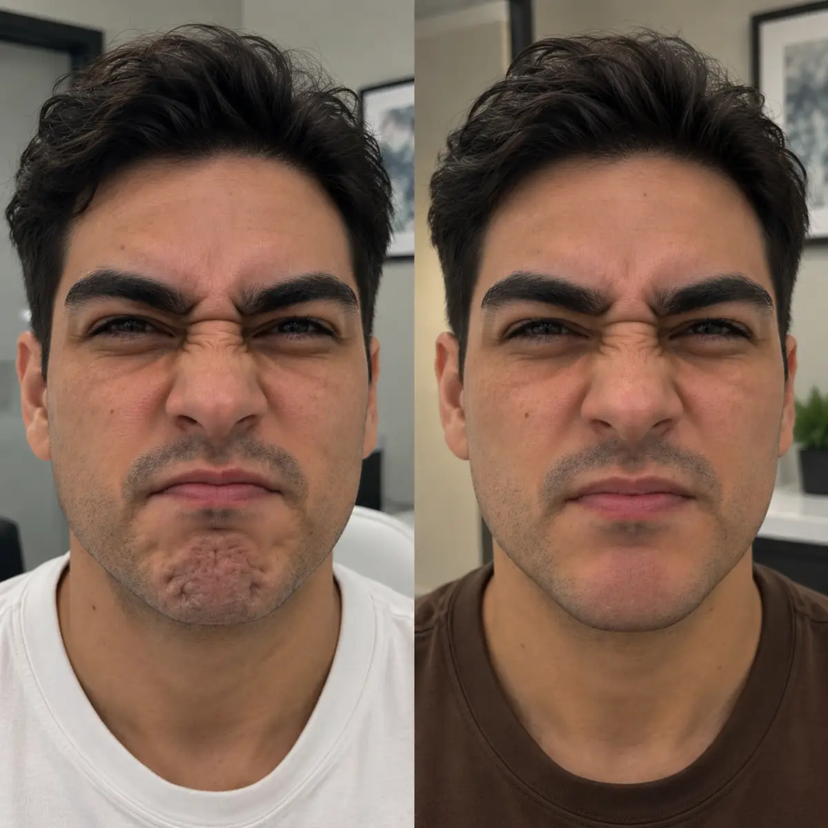 Male patient before and after Chin Letybo Grapevine TX showing reduced mentalis muscle dimpling