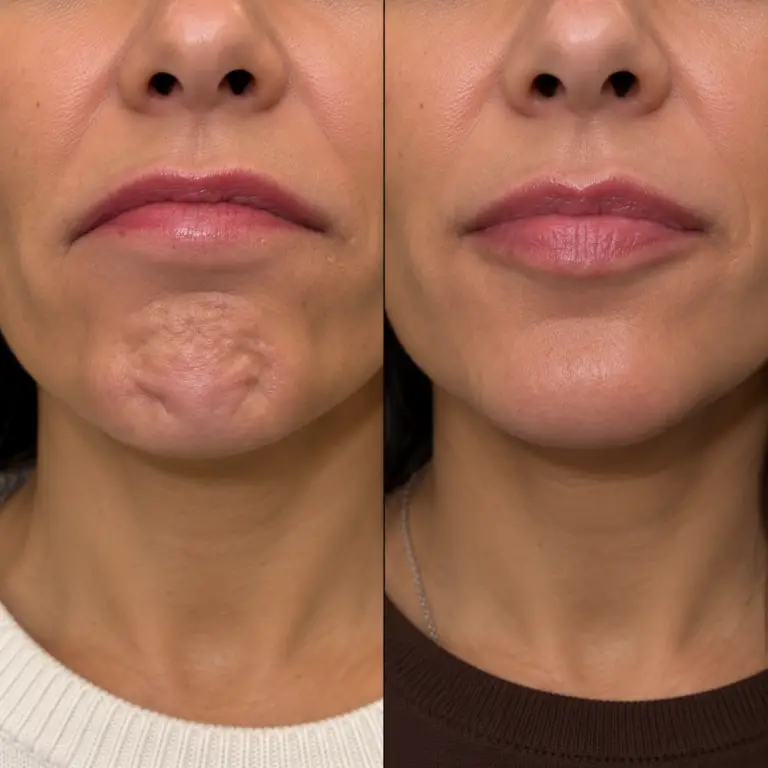 Before and after Chin Letybo in Grapevine TX showing reduced dimpling and smoother chin texture