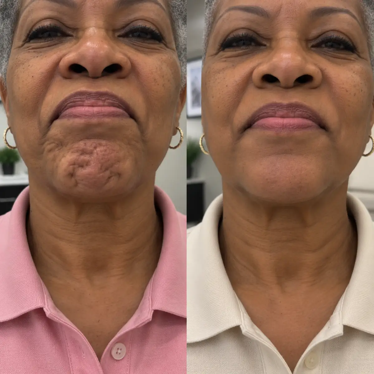 Older woman before and after Chin Letybo Grapevine TX showing improvement in dimpled chin texture