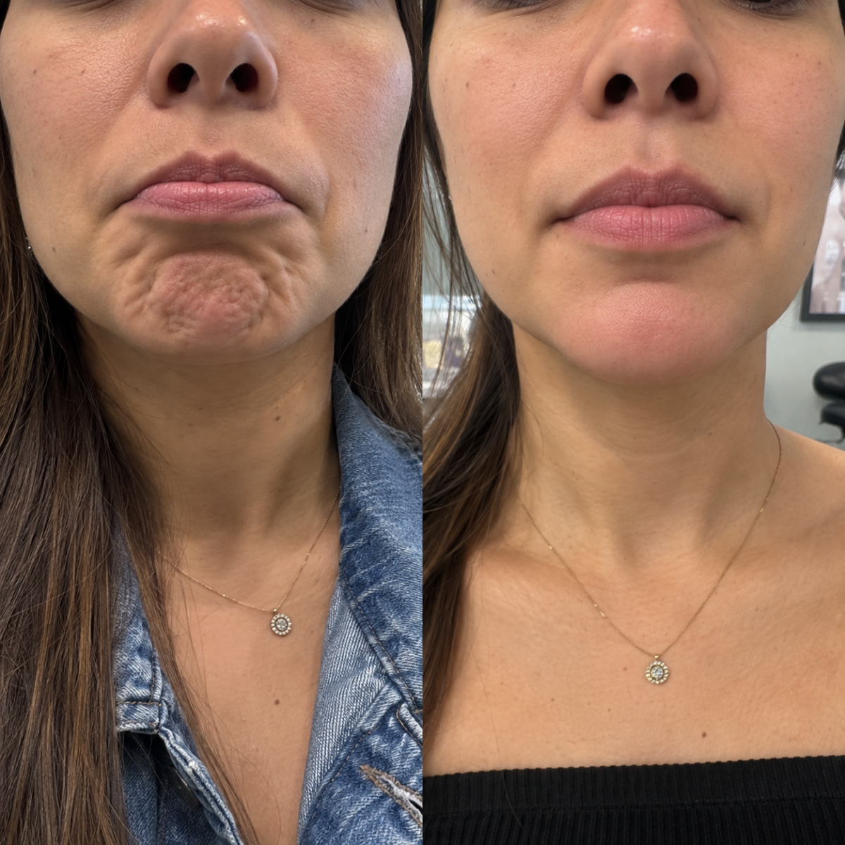 Chin Letybo Grapevine TX before and after showing smoother dimpled chin texture
