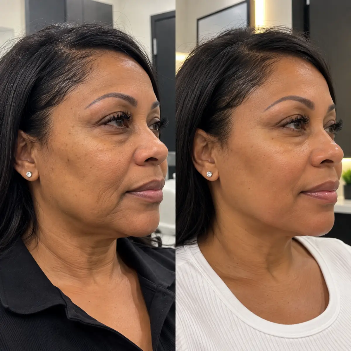 Laser Skin Tightening Grapevine TX before and after showing improved facial firmness and skin texture in a Black woman