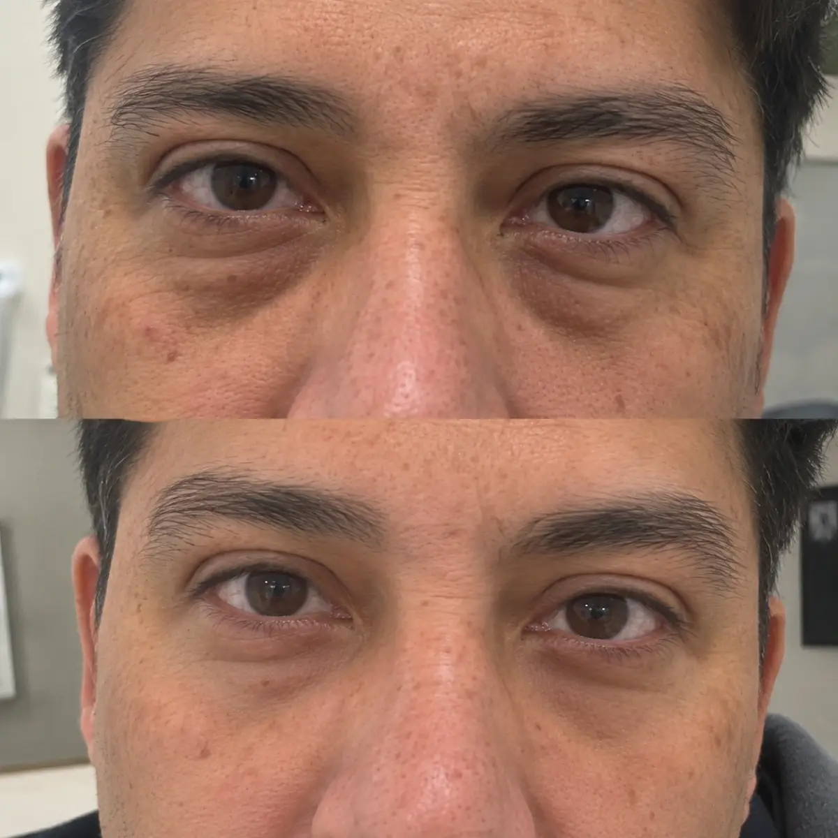 PRP Under Eyes before and after in Grapevine TX showing reduced under-eye hollows, smoother skin, and improved eye rejuvenation after treatment