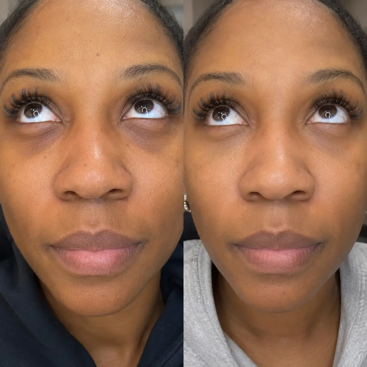 PRP Under Eyes Grapevine TX before and after showing brighter under-eye appearance and reduced dark circles after PRP treatment