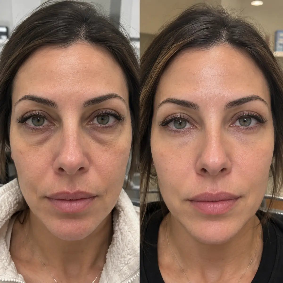 PRP Under Eyes Grapevine TX before and after showing smoother under-eye skin, softer fine lines, and refreshed appearance