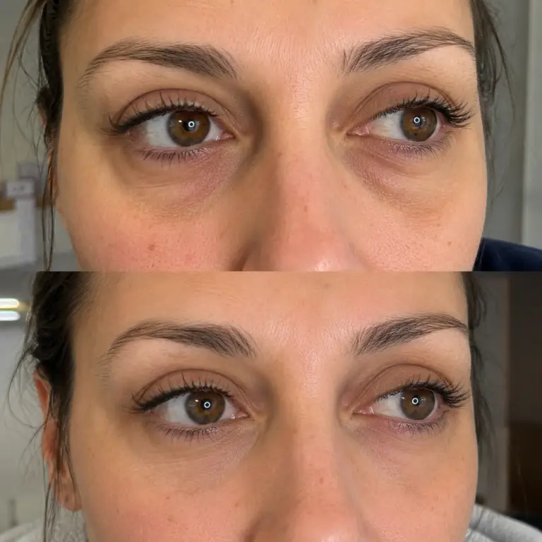 PRP under-eye treatment before and after in Grapevine TX demonstrating smoother under-eye skin and reduced crepey texture after four months