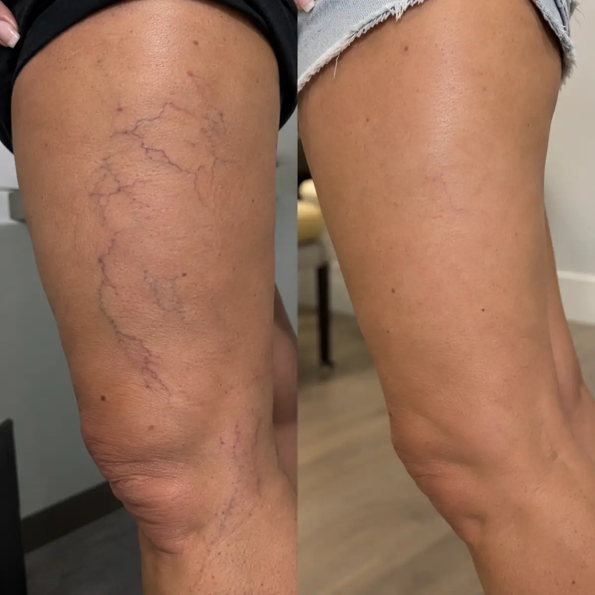 Before and after laser treatment for spider veins on the thigh, showing significant reduction of visible superficial leg veins with natural-looking skin.