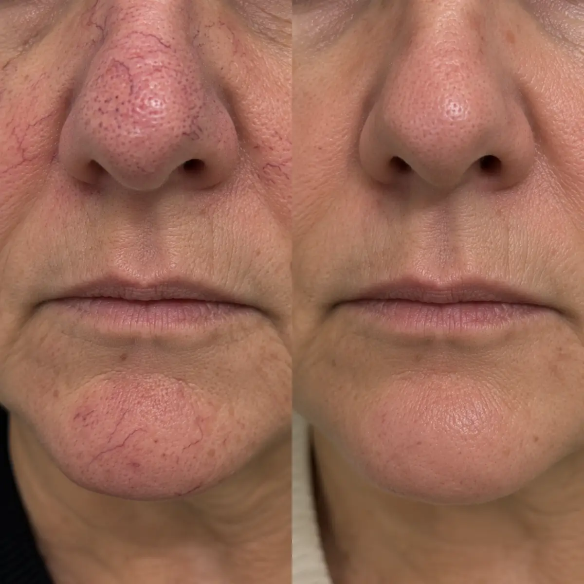 Before and after Spider Vein Treatment Grapevine TX for facial spider veins on the nose and chin, showing visible broken capillaries before treatment and significantly clearer skin afterward while maintaining natural skin texture.