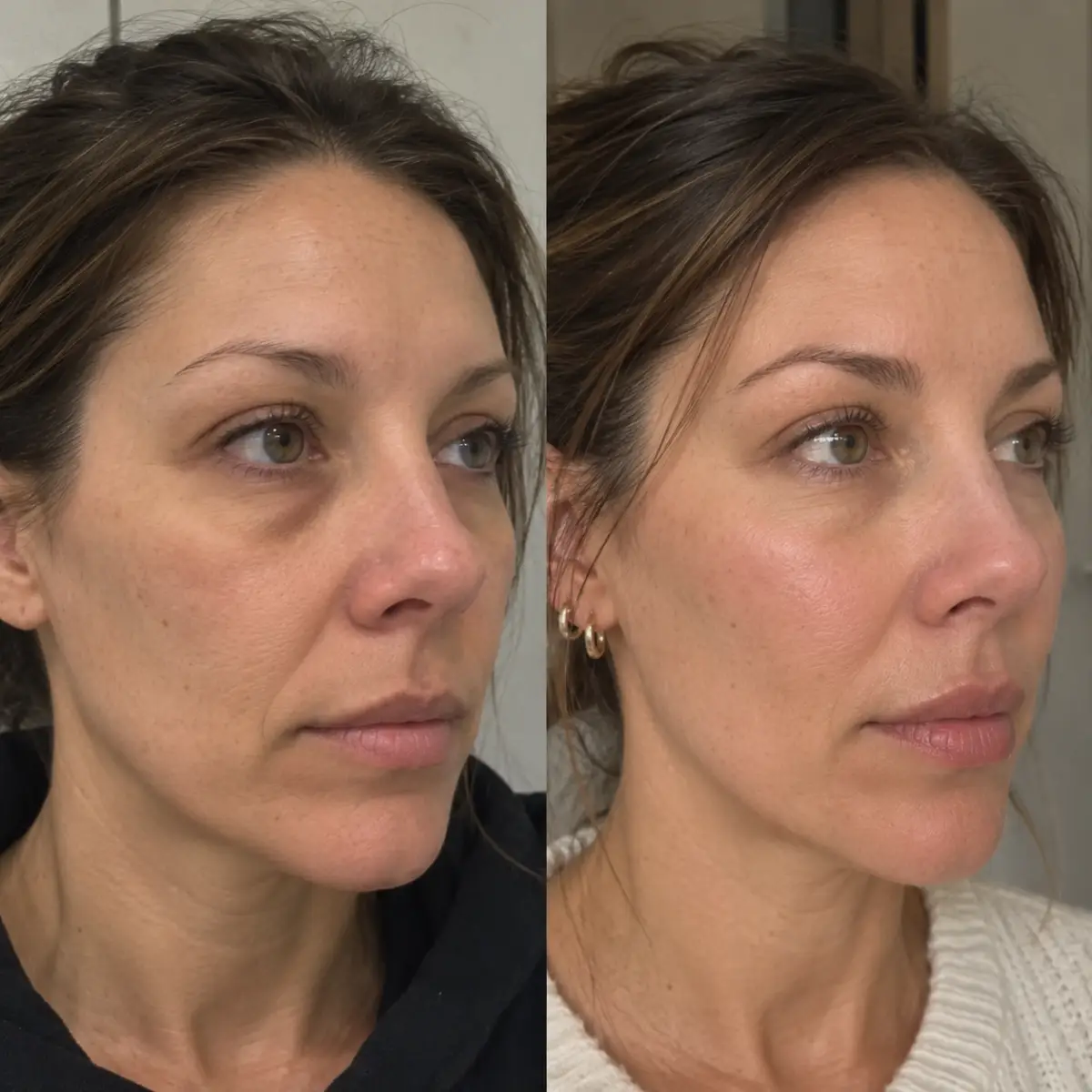 Three-quarter before and after Sculptra treatment showing improved facial volume, healthier skin texture, and natural-looking facial rejuvenation.
