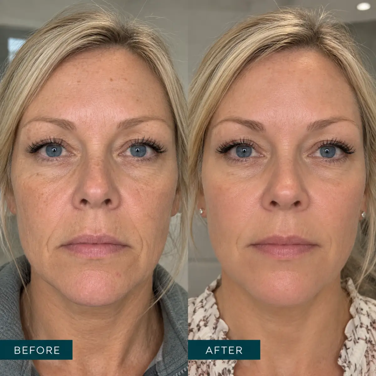 Vampire Facial Grapevine TX before and after showing improved skin firmness, texture, and facial rejuvenation after 3 months